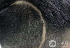 疤痕植發(fā)的一般價(jià)格是多少？疤痕植發(fā)*嗎？