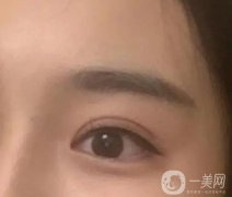 如何讓雙眼皮消腫更快？肉條多久會消失？