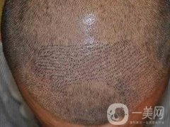 男性脫發(fā)怎么辦?哪些方面會(huì)影響植發(fā)的果?