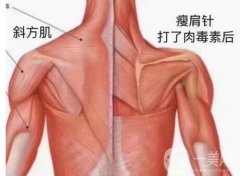 注射瘦肩會(huì)影響肩部動(dòng)作嗎?如何注射注射瘦肩【步驟解析】