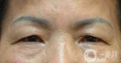 眼皮為什么會下垂?原因大合集及恢復(fù)辦法