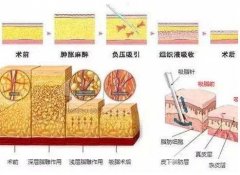 腹部吸脂的價(jià)格要多少?*嗎?
