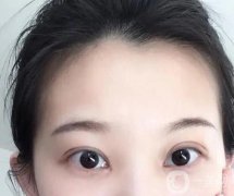 全切雙眼皮肉條和腫脹的區(qū)別是什么？感染的表現(xiàn)是什么？
