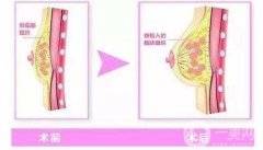 自體脂肪豐胸能維持多久呢?需要多久恢復(fù)?