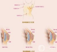 隆胸假體如何選擇?形狀、材料、罩杯等