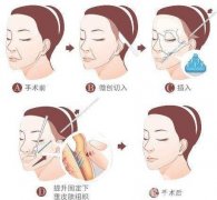 全臉拉皮多少錢?拉皮手術(shù)后的注意事項(xiàng)有哪些?