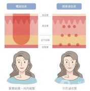 拉皮多少錢(qián)?拉皮手術(shù)能持續(xù)多久?