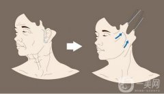 拉皮手術(shù)價(jià)格多少錢(qián)?影響因素有哪些?