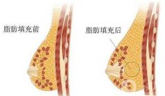 自體脂肪隆胸失敗會(huì)怎樣?自體脂肪隆胸為什么會(huì)失敗?