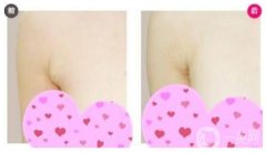 副乳吸脂術(shù)是什么，如何做副乳吸脂術(shù)