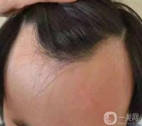 發(fā)際線高怎么辦?做頭發(fā)線移植手術(shù)要多少錢(qián)?