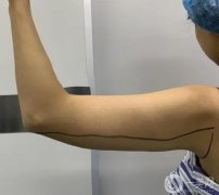 手臂抽脂會不會反彈？術(shù)后如何護(hù)理？