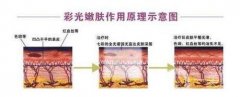 彩光嫩膚做一次*嗎，需要多長時間見?