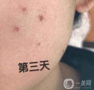 藥水點(diǎn)痣和激光點(diǎn)痣的原理，及優(yōu)缺點(diǎn)