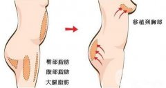 自體脂肪隆胸前后的注意事項(xiàng)介紹