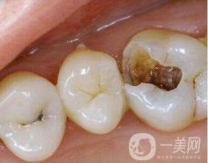 用什么材料補(bǔ)牙洞好？