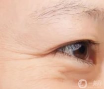 魚尾紋打玻尿酸有用嗎？玻尿酸注射魚尾紋是否*？