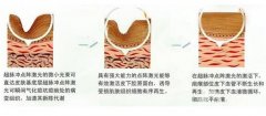點(diǎn)陣激光后需要多久才能恢復(fù)正常?