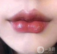 唇珠對于女生意味著什么呢，玻尿酸豐唇珠是否*