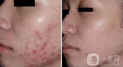 果酸換膚和光子嫩膚哪個更好?