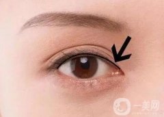 紋了美瞳線后眼睛腫應該怎么辦？