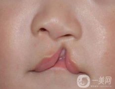 唇腭裂分類有哪些?唇腭裂修復(fù)前的注意事項(xiàng)有哪些?