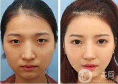 開內(nèi)眼角會(huì)不會(huì)留下傷疤呢，留疤了怎么辦