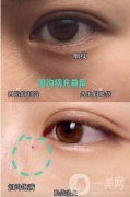 淚溝填充的常見方法有哪些?