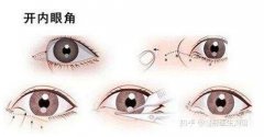 開眼角可以吃雞蛋嗎?開眼角飲食禁忌