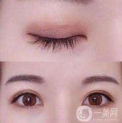 埋線雙眼皮存在風(fēng)險(xiǎn)后遺癥嗎?