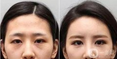 淚溝可以通過(guò)手術(shù)和注射玻尿酸嗎