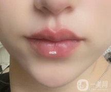 隆唇手術(shù)的價(jià)格大概是多少?