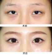 開內(nèi)眼角會(huì)不會(huì)回縮，哪些人適合，哪些人不適合?