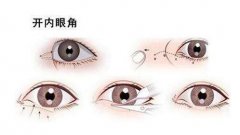 開眼角有什么風(fēng)險(xiǎn)呢?術(shù)后怎么護(hù)理?