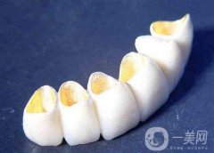 烤瓷牙對(duì)身體有害嗎，烤瓷牙有哪些檢查?