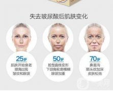 玻尿酸有什么作用?常見(jiàn)玻尿酸產(chǎn)品介紹