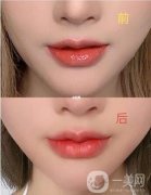 玻尿酸隆唇怎么樣?玻尿酸隆唇術(shù)后的注意事項(xiàng)