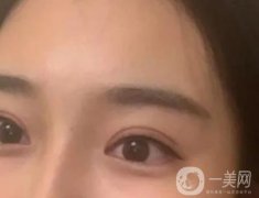 雙眼皮手術(shù)后應(yīng)該注意什么?事項(xiàng)仔細(xì)看看！
