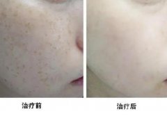 *能讓皮膚變薄嗎？什么是超*激光？