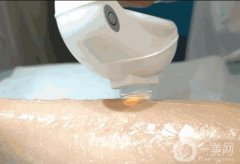 腿毛很多的原因是什么？激光脫毛有哪些注意事項(xiàng)？