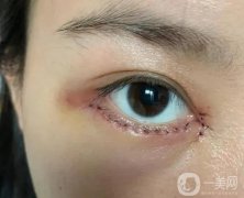 外切眼袋外翻恢復(fù)需要多長時間？為什么會出現(xiàn)這種情況？