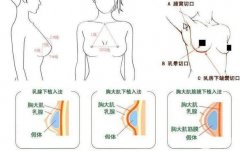 乳房整形前后！手術(shù)后遺癥及處理措施一覽