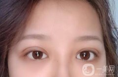 開(kāi)眼角會(huì)留下疤痕嗎?開(kāi)眼角手術(shù)后多久能康復(fù)？