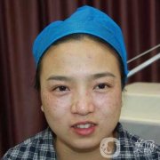 激光祛斑后間隔多久可以化妝，激光去斑的優(yōu)缺點(diǎn)