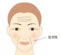 玻尿酸去除法令紋怎么樣，有什么危害?