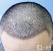 植發(fā)的一般價(jià)格是多少?頭發(fā)稀疏可以植發(fā)嗎?