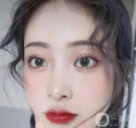 割雙眼皮一般要多少錢?什么時(shí)候割雙眼皮合適?