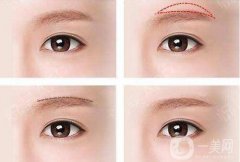 切眉可以熬夜嗎，切眉熬夜有什么不好的的影響?