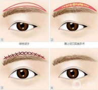切眉和提眉哪個(gè)更好，切眉相關(guān)手術(shù)介紹