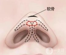 鼻尖整形多少錢？有哪些因素影響？